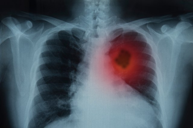 Na svaka dva sata u Srbiji jedna osoba umre od raka pluća: Najveći faktor rizika – cigarete