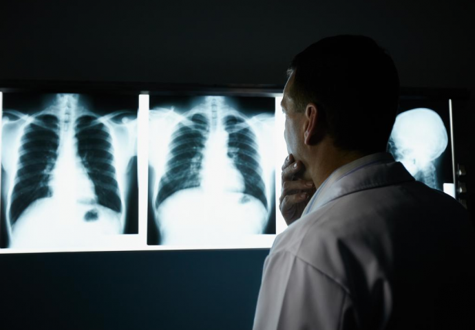 Nakon Kine, i u Evropu stigla bolest ‘Sindroma bijelih pluća‘. Otporna je na penicilin, govori se o novoj epidemiji