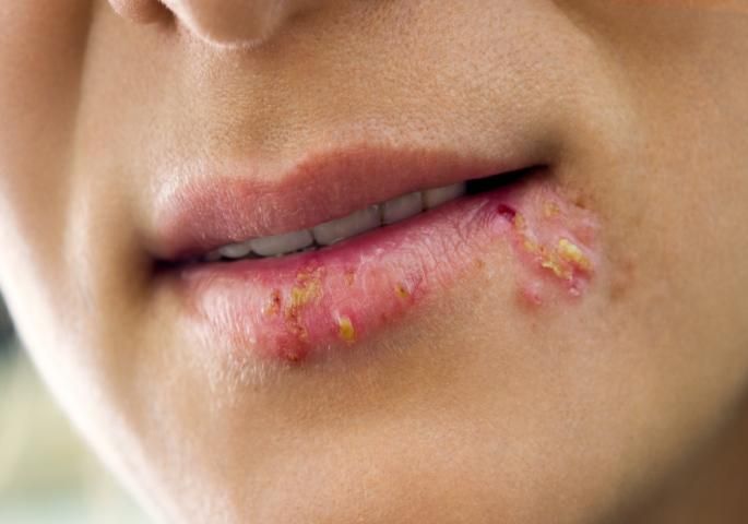 Herpes se LAKO PRENOSI – Siguran je znak PADA IMUNITETA, obavezno reagujte u slučaju da vam izađe